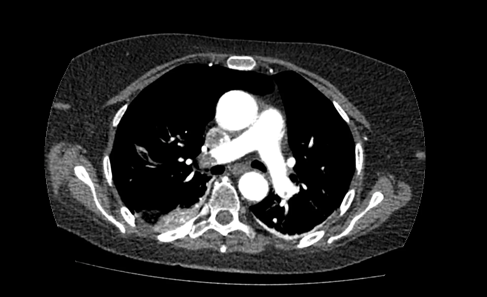 Raw CT chest scan showing pulmonary structures