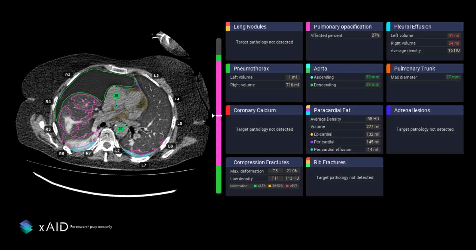 CT scan with AI annotations showing lung nodules, pleural effusion, aorta measurements and other findings